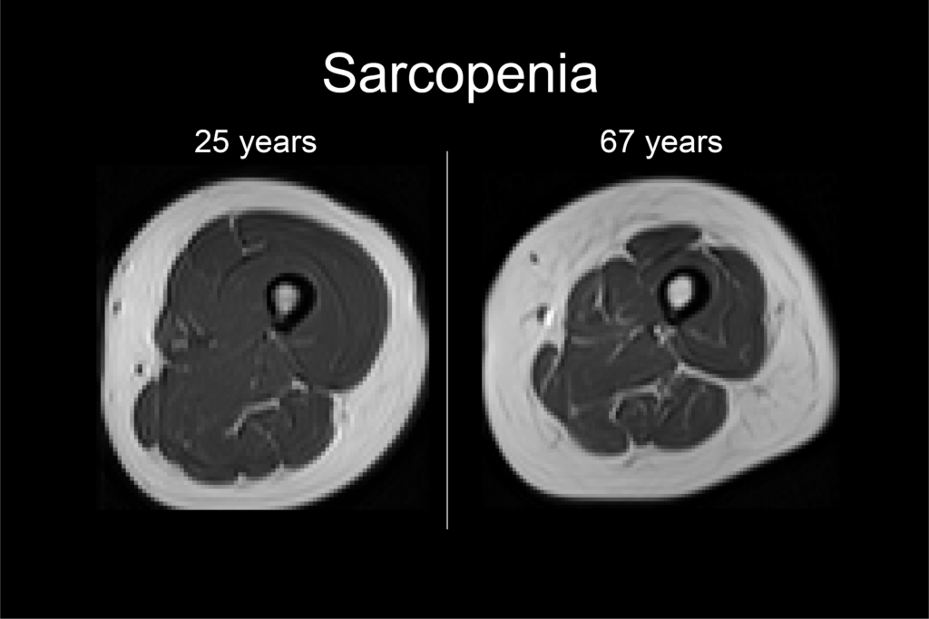 Sarcopenia